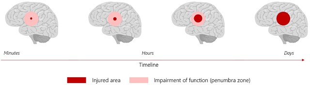 Nyrada brain stroke death of brain cells