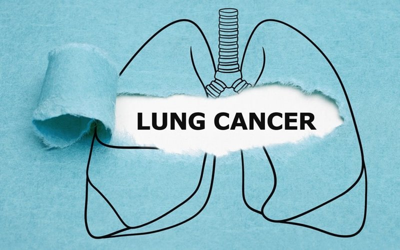 Radiopharm receives approval for Phase 1 therapeutic study of NSCLC